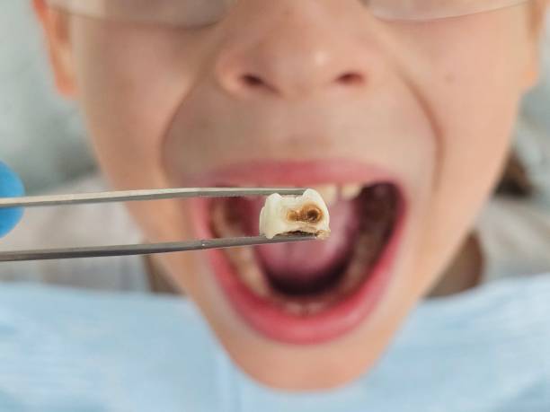 Best Emergency Tooth Extraction in White Bear Lake, MN